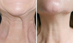 Nefertiti Neck Lift before and after illustration
